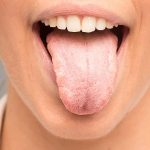 Чому тріскається язик і що з цим робити?