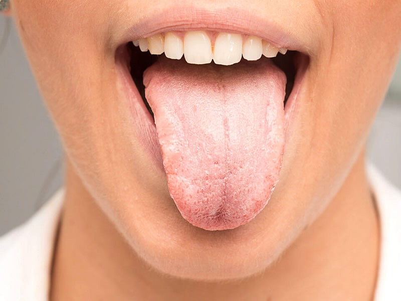 Чому тріскається язик і що з цим робити?